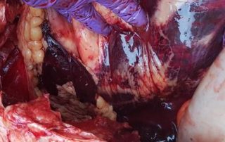 Mesenteric Vessel Rupture